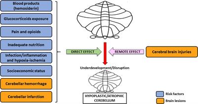 Cerebellum and Prematurity: A Complex Interplay Between Disruptive and Dysmaturational Events